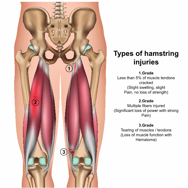 5 Most Common Injuries In Soccer. What You Need To Know