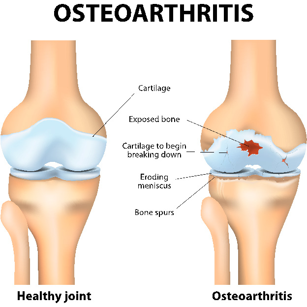 What Causes Lateral Knee Pain?