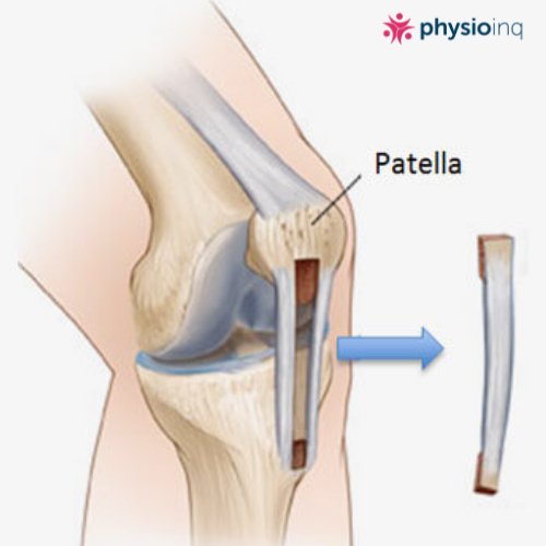 Patella Tendon Graft